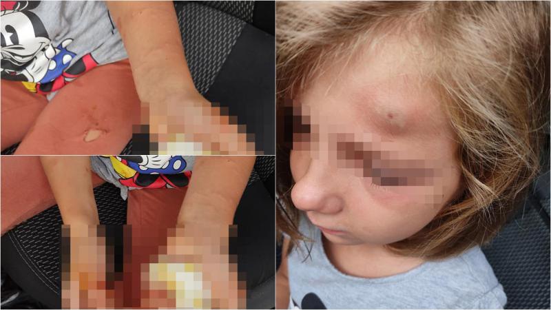  (foto) Clipe de coșmar pentru o fetiță de 6 ani: A ajuns în ghearele unui câine, în timpul unei plimbări